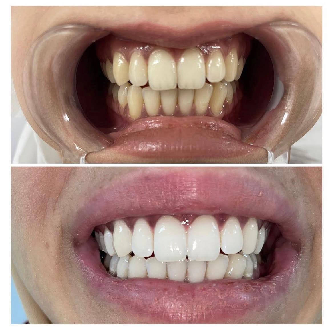 Tanden bleken behandeling in de salon