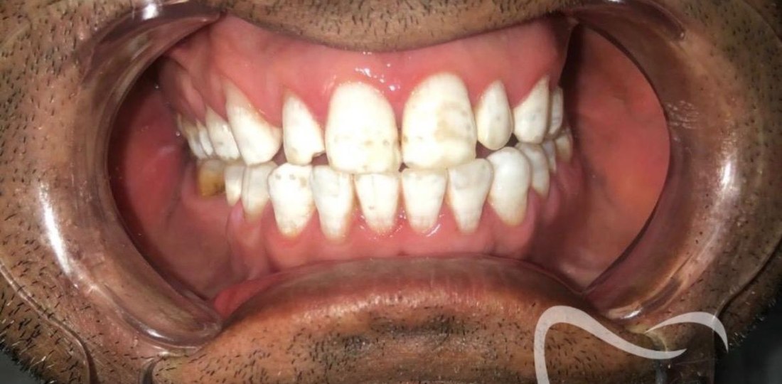 Tanden na Billion Dollar Smile behandeling