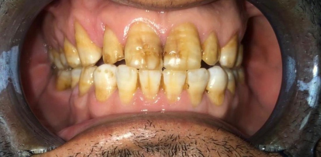 Tanden voor Billion Dollar Smile behandeling