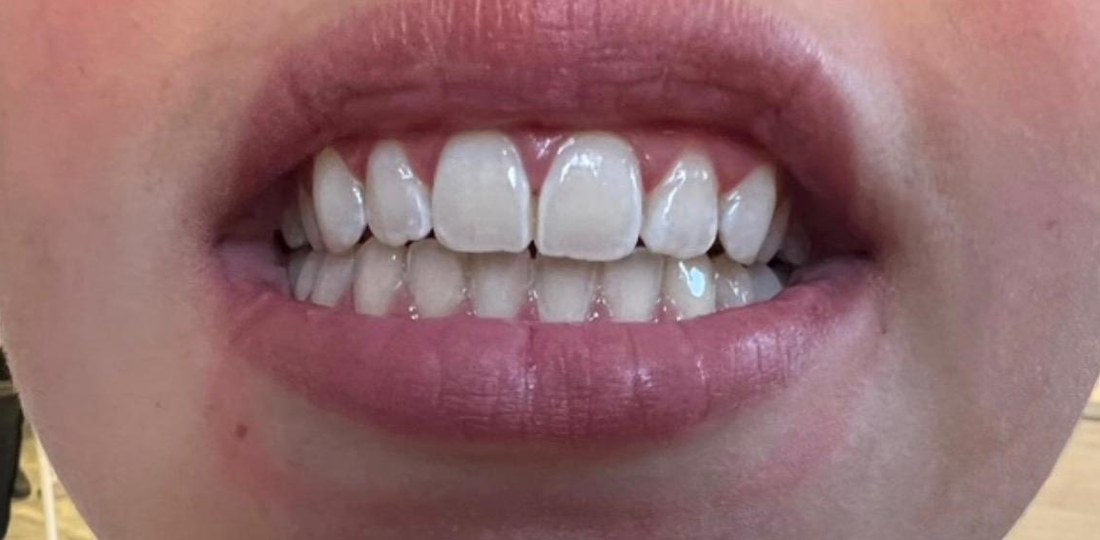 Tanden na Hollywood Smile behandeling