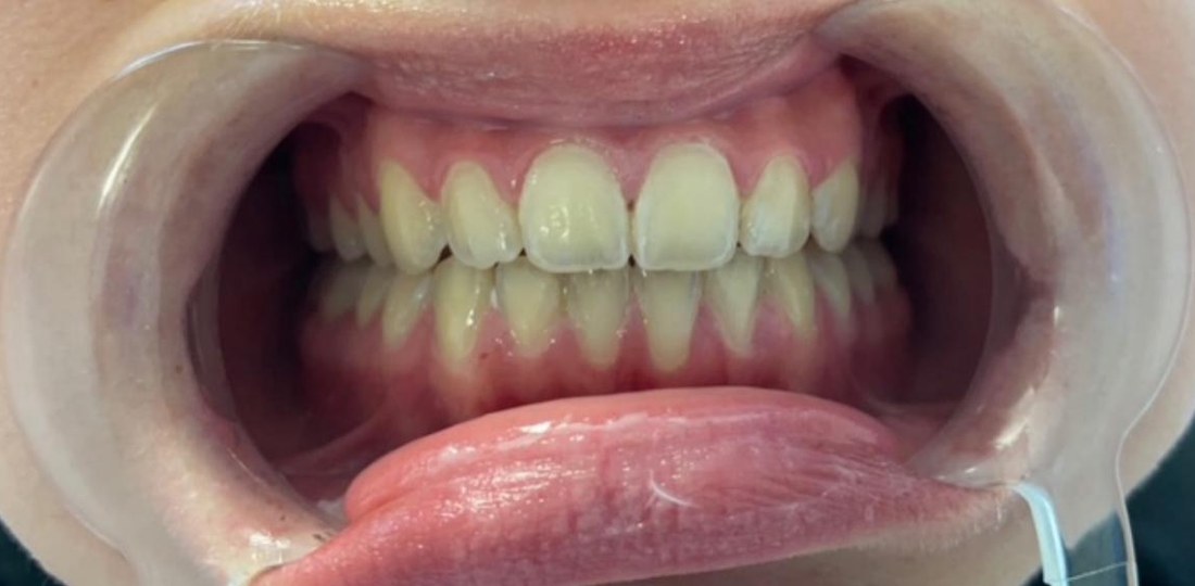 Tanden voor Hollywood Smile behandeling