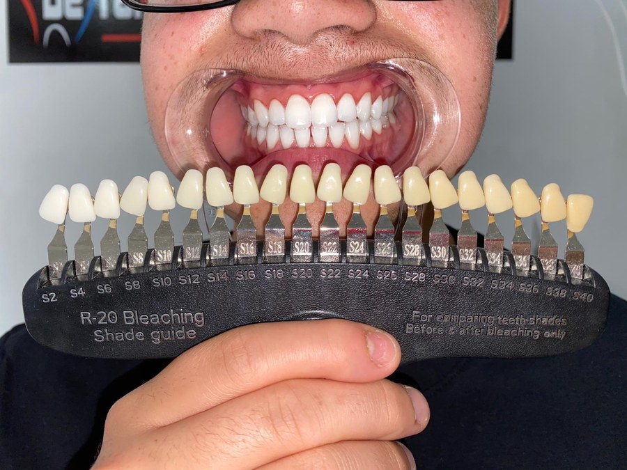 Klant vergelijkt tandkleur met professionele shadeguide bij De Tandenbleker Antwerpen